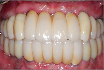 수면마취하 전체임플란트 case2 after