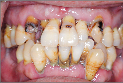 수면마취하 전체임플란트 case2 before