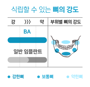 식립할 수 있는 뼈의 강도